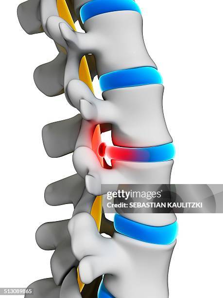 ilustraciones, imágenes clip art, dibujos animados e iconos de stock de slipped disc, artwork - vértebra humana
