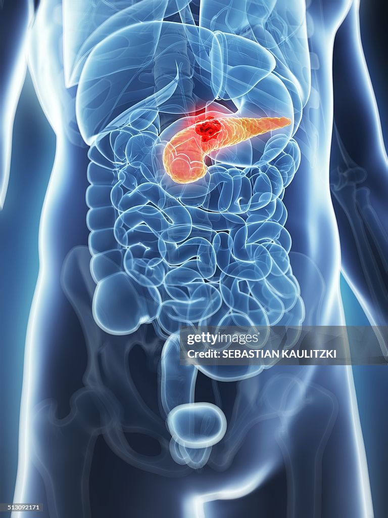 Human pancreas showing tumor, artwork