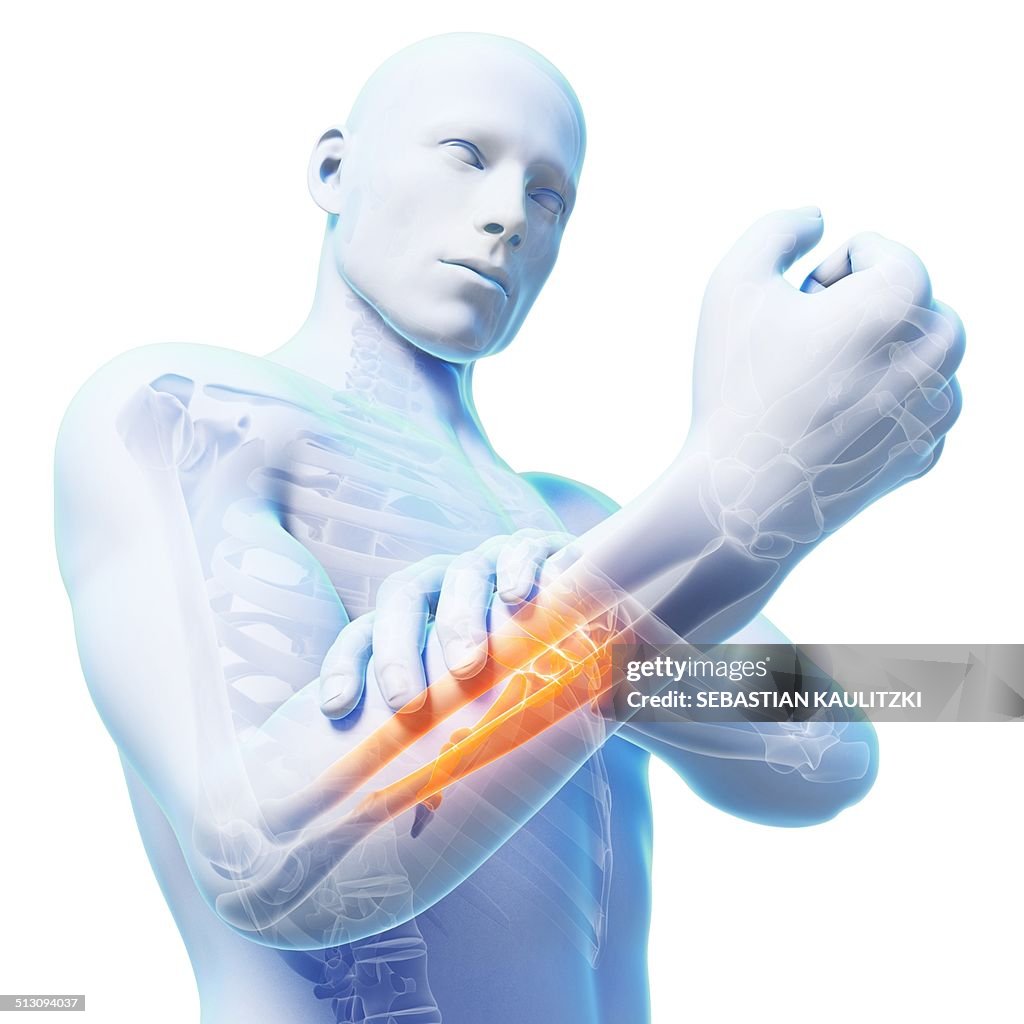 Human arm pain, artwork