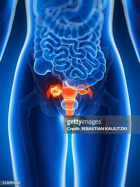 female uterus with tumor, artwork - menschliche gebärmutter stock-grafiken, -clipart, -cartoons und -symbole
