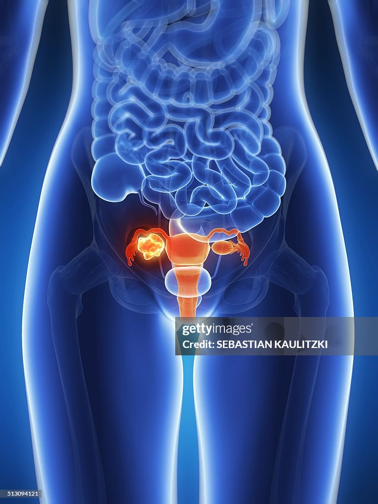 Female uterus with tumor, artwork