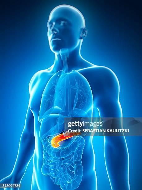 stockillustraties, clipart, cartoons en iconen met human pancreas showing tumor, artwork - pancreatic cancer