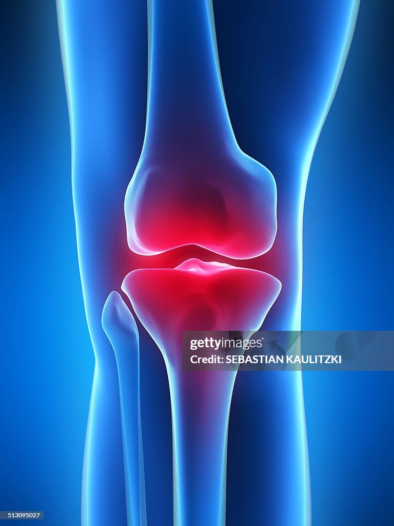 Human knee pain, artwork