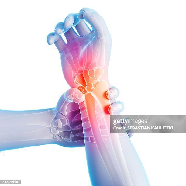 human wrist pain, artwork - handgelenk stock-grafiken, -clipart, -cartoons und -symbole
