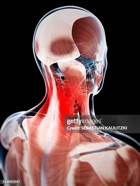 human neck pain, artwork - neck muscle pain illustration stock illustrations