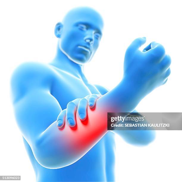 human arm pain, artwork - arthritis hand 3d stock illustrations