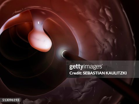 Polyp found during a colonoscopy, artwork Polyp found during a colonoscopy, artwork