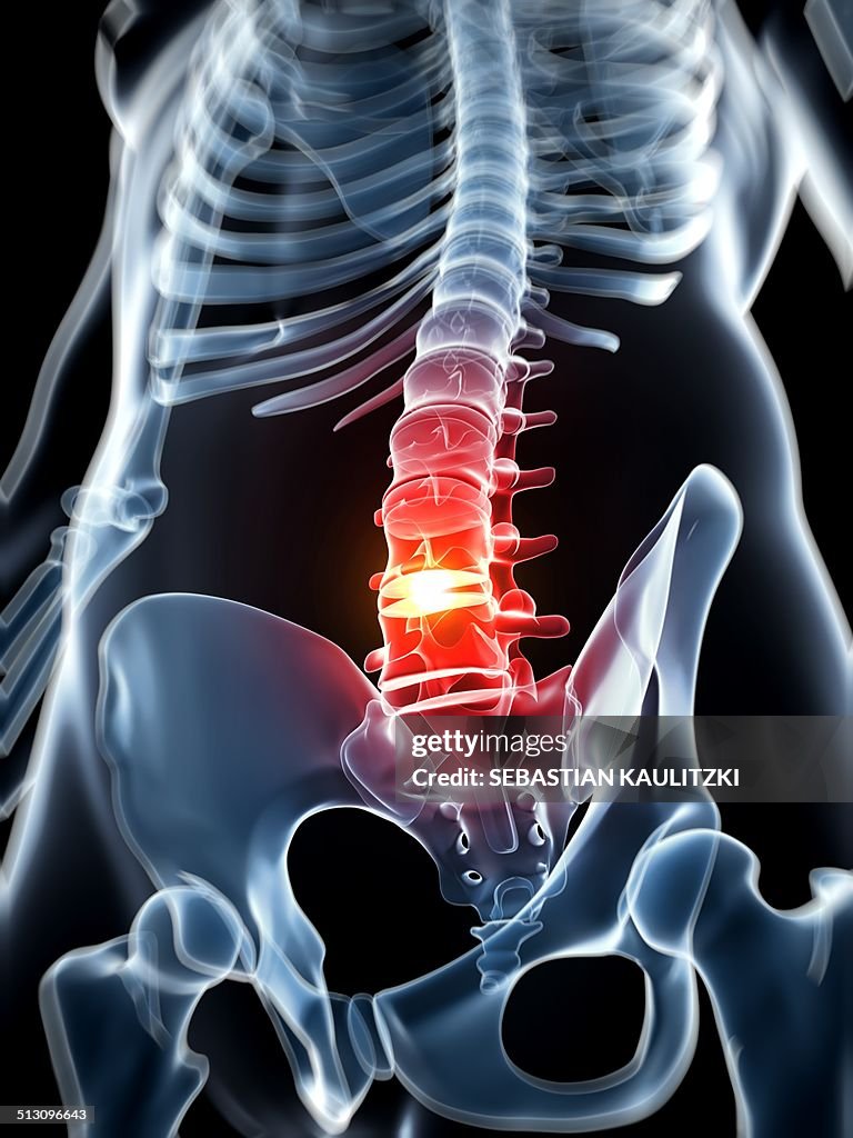 Human spine with slipped disc, artwork