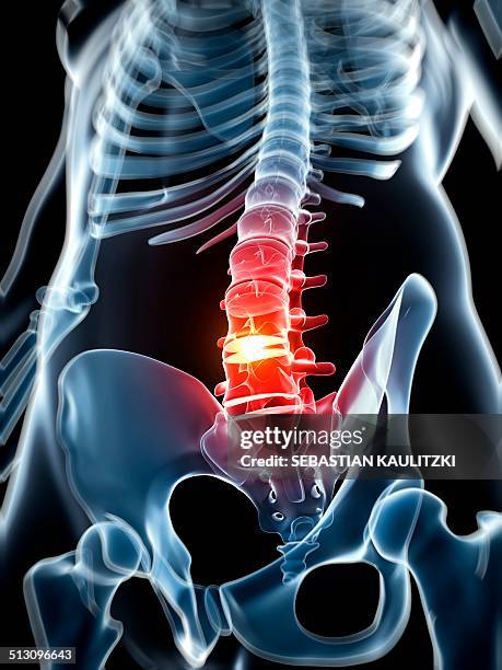 human spine with slipped disc, artwork - hernia stock illustrations