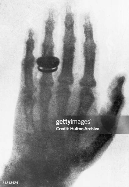 One of the first X-ray photographs, taken by the German physicist Wilhelm Conrad Roentgen and showing his wife's hand, 23rd January 1896.