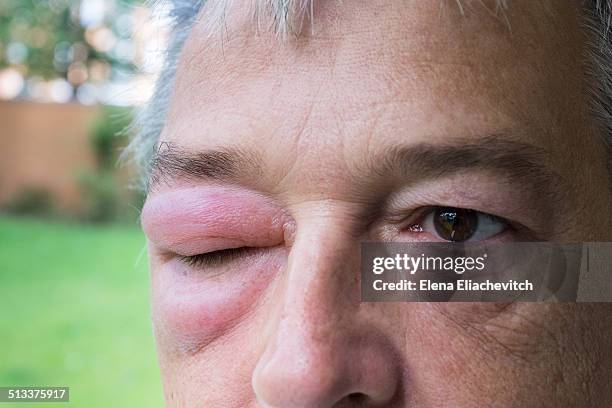 man with swollen eye - bug bite stock pictures, royalty-free photos & images