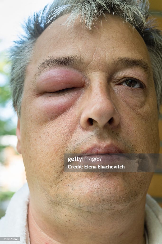 Man with swollen eye