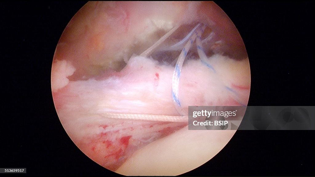 Shoulder, arthroscopy.