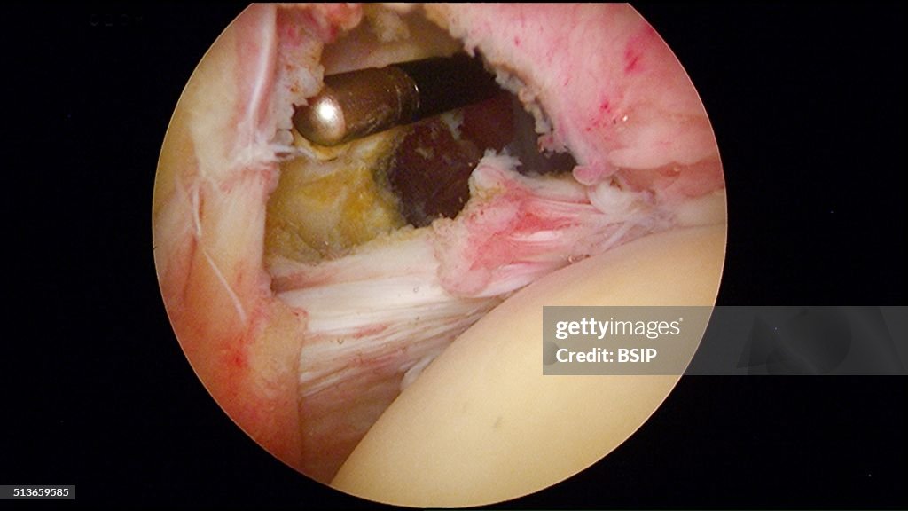 Shoulder, arthroscopy.
