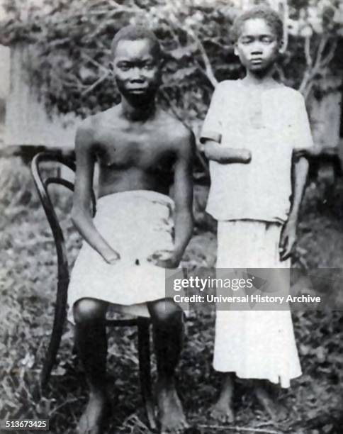 Amputation was frequently used to punish workers in the Congo Free State, controlled by Leopold II of Belgium, 1900.