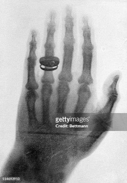 Ray: One of the first X-ray photographs made by Professor Konrad Roentgen in 1898.