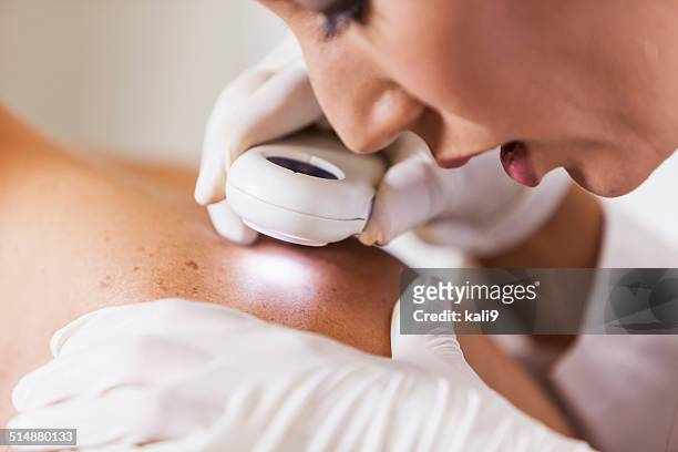 dermatologist examining patient for signs of skin cancer - human skin stock pictures, royalty-free photos & images
