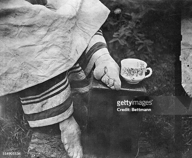 Disfigured feet of a Chinese woman. Cruel custom of bandaging feet of women of the aristocracy from infancy was still practiced around 1900.