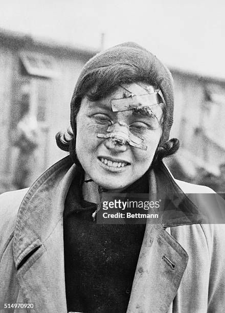 Victim of Nazi Brutality Liberated From Belsen 1945