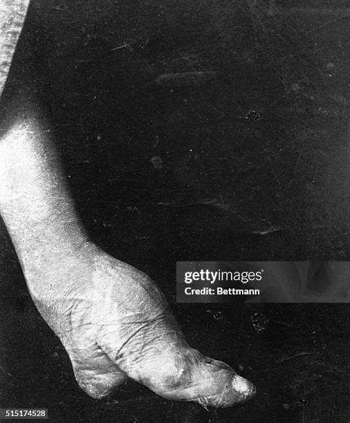 The atrocious pain of Chinese foot binding usually starts around age four for women and requires wrapping bandages tightly around the foot. The...
