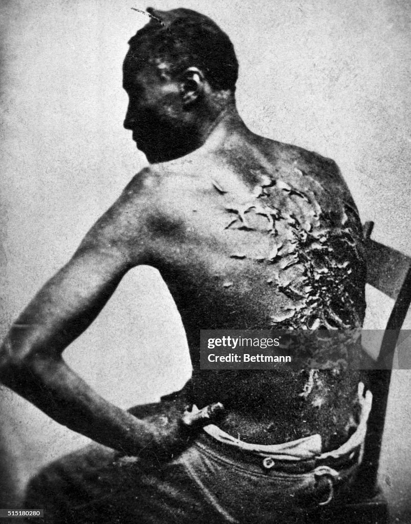Rear View of Former Enslaved Man Revealing Scars at Medical Inspection