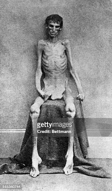 An emaciated Union soldier is shown upon his release from the Confederate prison Camp Sumter, located in Andersonville, Georgia.