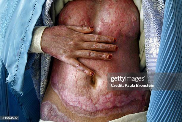 Masooma, 18-years-old, who suffers with severe burns on 70% of her body from self-immolation, shows her scars on her belly at the Herat Regional...