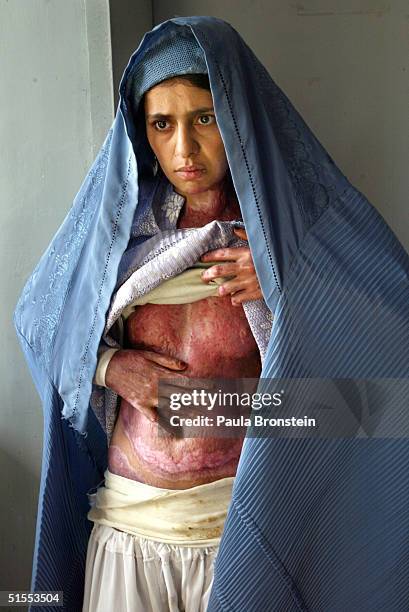 Masooma, 18-years-old, who suffers with severe burns on 70% of her body from self-immolation, shows her scars on her belly at the Herat Regional...