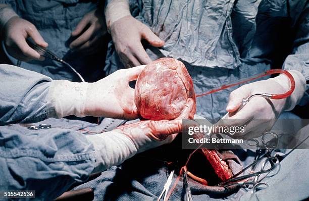 Suturing of donor's heart in to James B. Cobb during 5/5/68 heart transplant operation at St. Luke's Hospital by team under Denton Cooley.