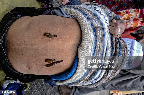 Leeches suck blood from the back of a Kashmiri patient on March 21 in Srinagar, the summer capital of Indian administered Kashmir, India. Nowruz, the...