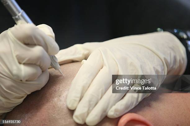 In Toronto on December 18, 2015A relateively new hair clinic is offering a different type of baldness treatment: micropigmentation, or tiny hair...