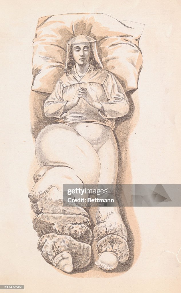 Illustration Depicting a Young Patient Disfigured with Elephantiasis