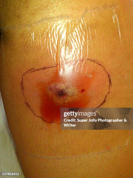 spider bite wound ulcer which healed - pressure ulcer stockfoto's en -beelden