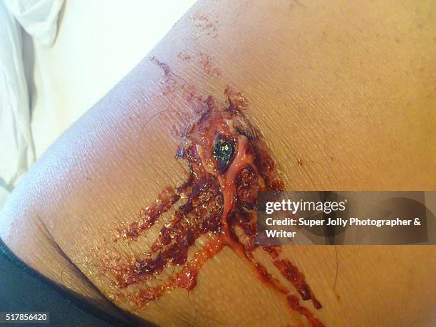 spider bite wound ulcer which healed - bug bite stock pictures, royalty-free photos & images