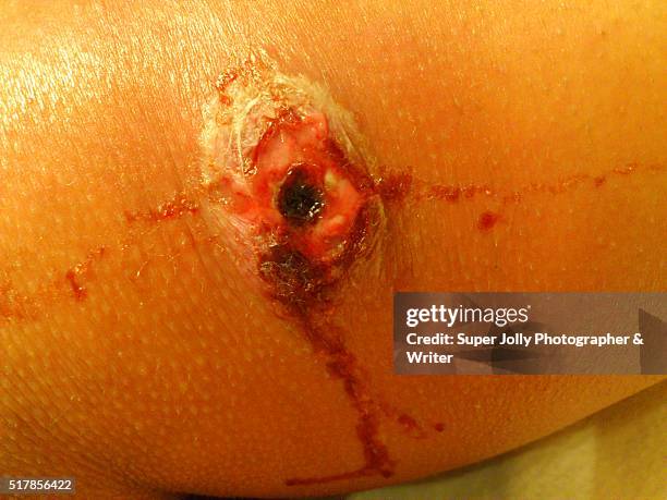 spider bite wound ulcer which healed - pressure ulcer stock pictures, royalty-free photos & images