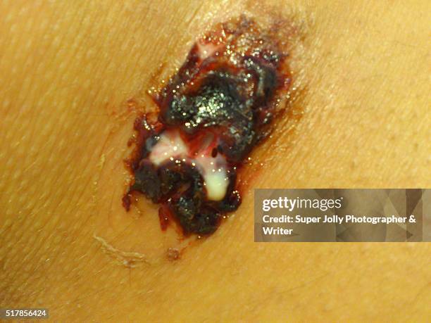 spider bite wound ulcer which healed - pressure ulcer stockfoto's en -beelden