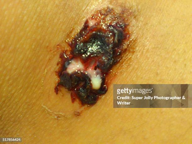 spider bite wound ulcer which healed - pressure ulcer stock pictures, royalty-free photos & images