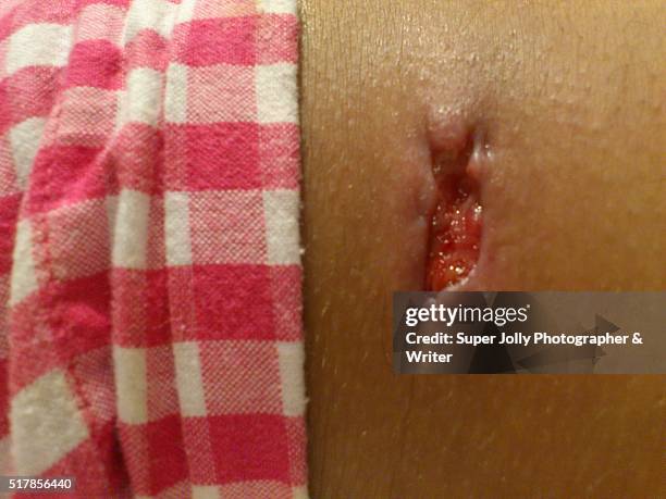 spider bite wound ulcer which healed - bug bite stock pictures, royalty-free photos & images