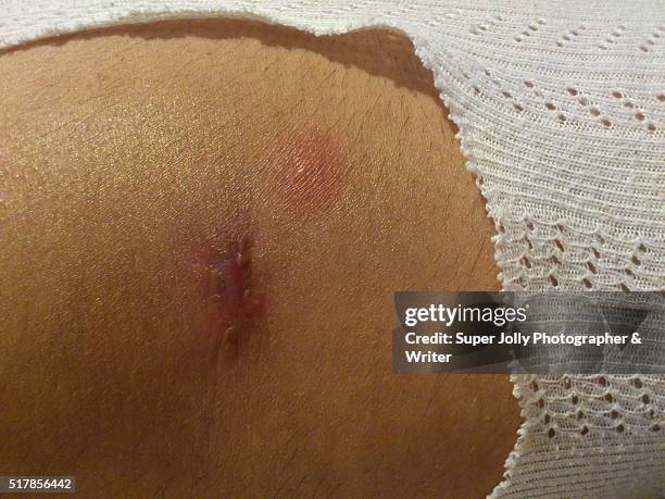 spider bite wound ulcer which healed - bug bite stock pictures, royalty-free photos & images