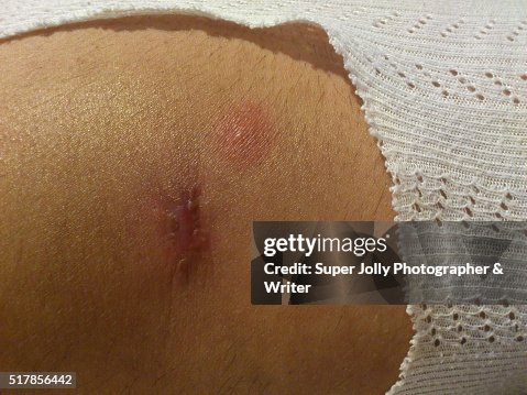 Spider bite wound ulcer which healed Spider bite wound ulcer which healed