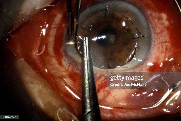 This image shows the suturing after replacement of an adult cornea in 1992 in the United States.