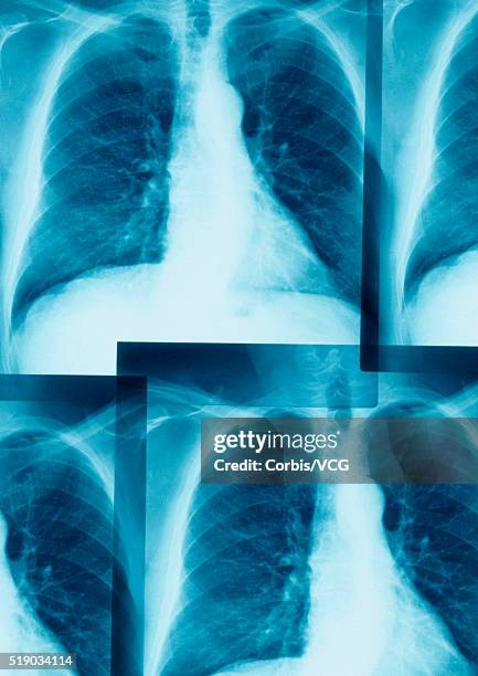 X Ray Accessory Rib Xrays Of A Rib Cage High-Res Stock Photo - Getty Images