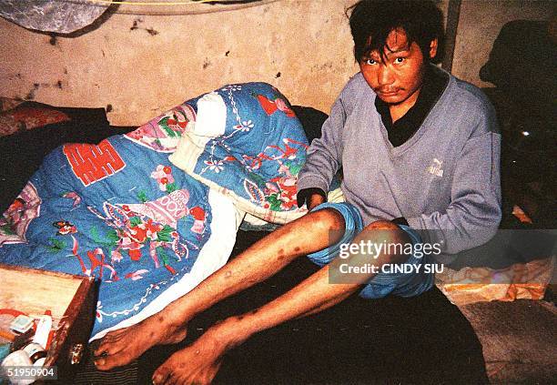 Sitting on his small bed 28 November 2000 in the village of Wenlou, China, Shi Hu is dying of AIDS after contracting the virus through selling his...