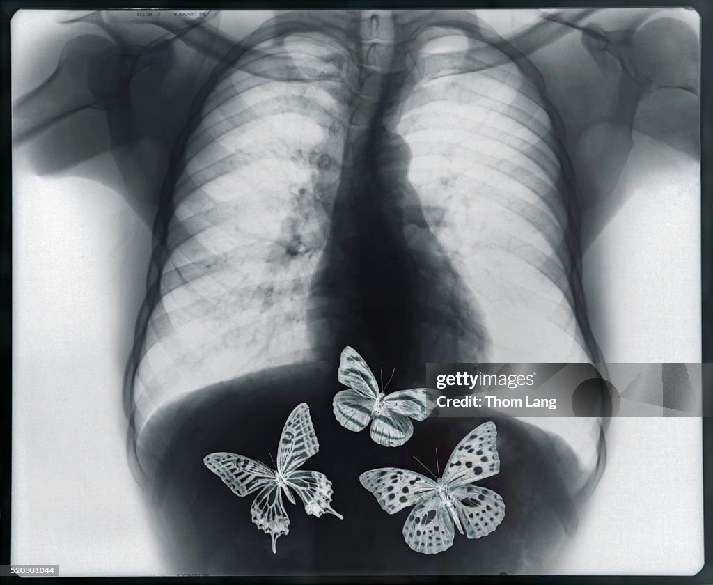 Xray Of Butterflies In The Stomach High Res Stock Photo Getty Images xray-of-butterflies-in-the-stomach-high-res-stock-photo-getty-images