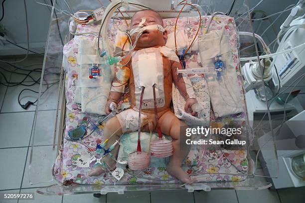 Ruslan Tertishny, aged three months, lies attached to medical apparatus as he recovers following his operation to correct severe birth defects in his...