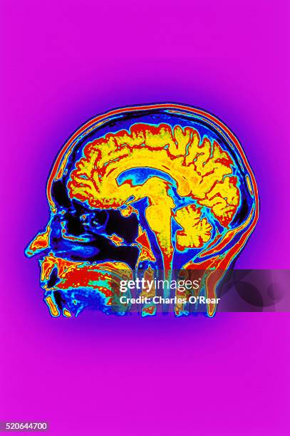 cat scan of a human head - brain scan stock-fotos und bilder