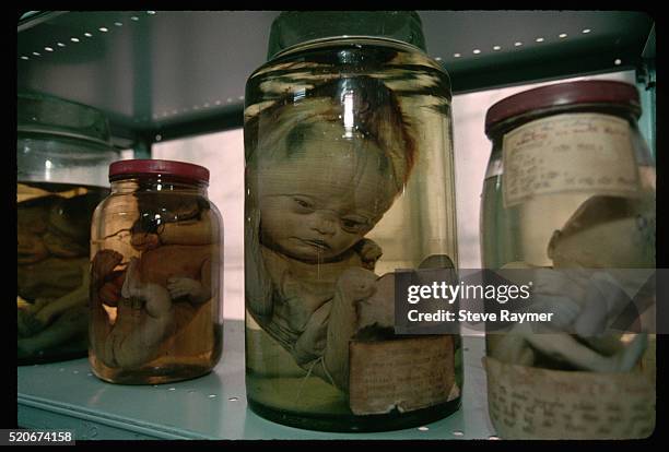 fetuses with birth defects - agent orange bildbanksfoton och bilder