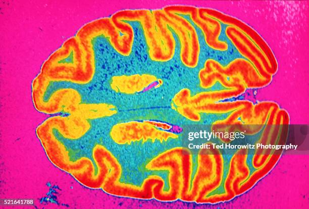 cross-sectional scan of brain - mri stock-fotos und bilder