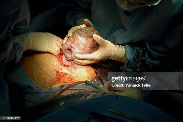 cesarean section - kassel stock-fotos und bilder