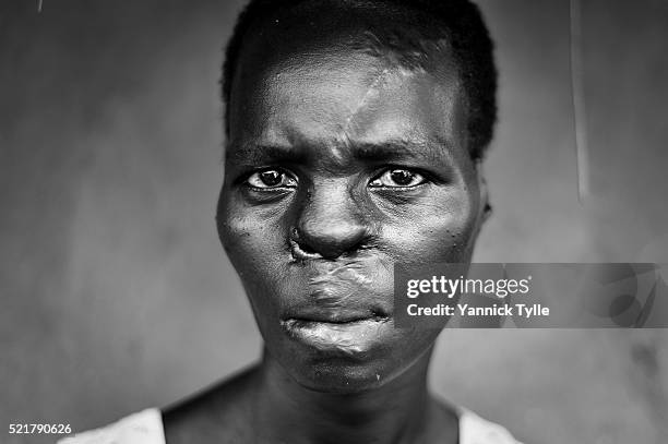 lra victim of mutilation - ugandan lord's resistance army stock pictures, royalty-free photos & images